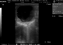 ultrasound of follicle