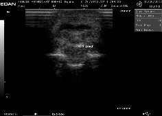 ultrasound of tendon